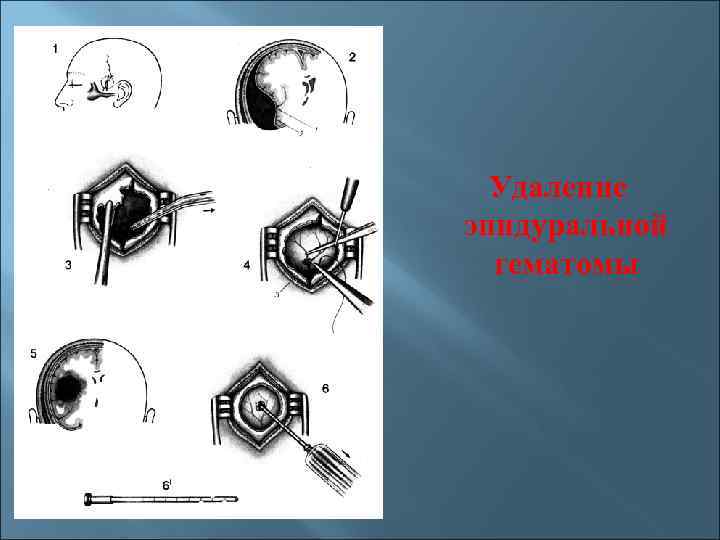 Удаление эпидуральной гематомы 