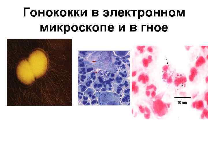 Гонококки в электронном микроскопе и в гное 