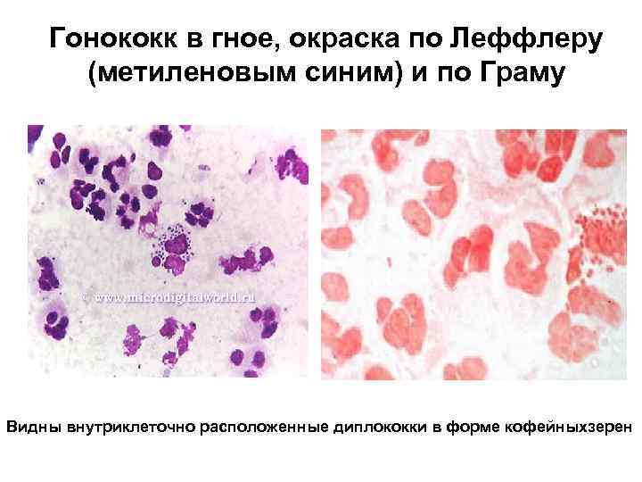 Гонококк в гное, окраска по Леффлеру (метиленовым синим) и по Граму Видны внутриклеточно расположенные