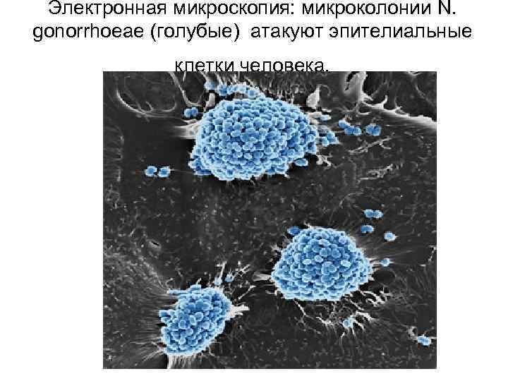 Электронная микроскопия: микроколонии N. gonorrhoeae (голубые) атакуют эпителиальные клетки человека. 