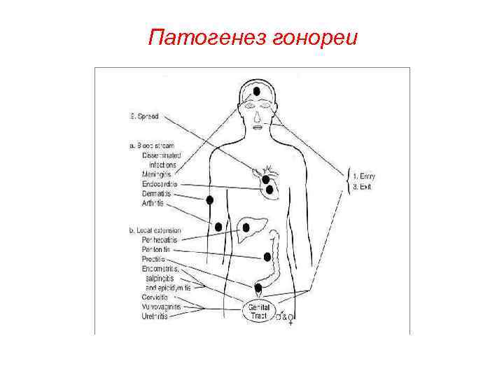 Патогенез гонореи 