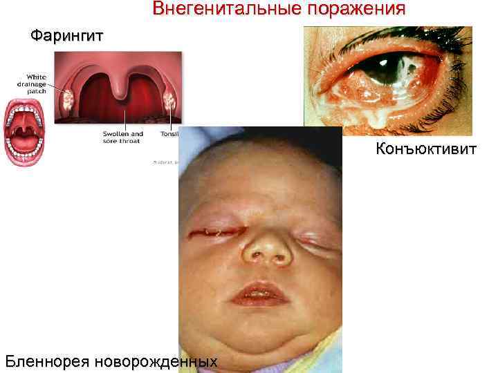 Внегенитальные поражения Фарингит Конъюктивит Бленнорея новорожденных 