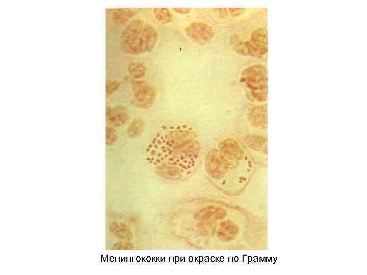 Менингококки при окраске по Грамму 