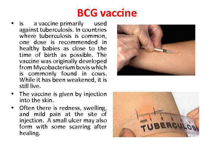 BCG vaccine • is a vaccine primarily used against tuberculosis. In countries where tuberculosis