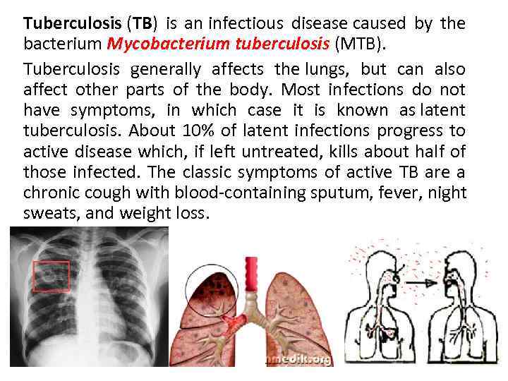 Tuberculosis (TB) is an infectious disease caused by the bacterium Mycobacterium tuberculosis (MTB). Tuberculosis