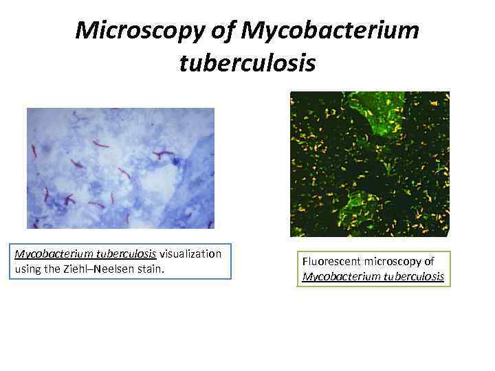 Microscopy of Mycobacterium tuberculosis visualization using the Ziehl–Neelsen stain. Fluorescent microscopy of Mycobacterium tuberculosis