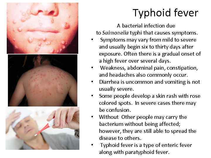 Typhoid fever • • • A bacterial infection due to Salmonella typhi that causes