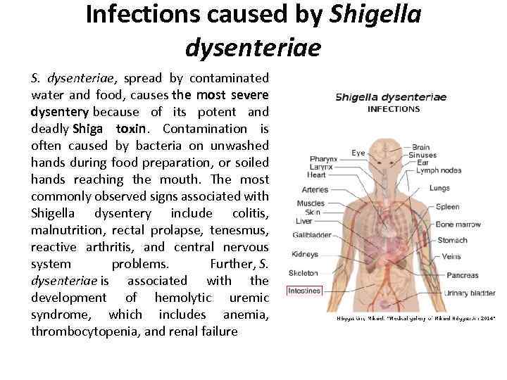 Infections caused by Shigella dysenteriae S. dysenteriae, spread by contaminated water and food, causes