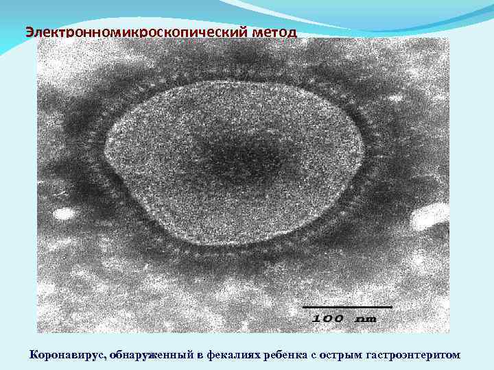 Электронномикроскопический метод Коронавирус, обнаруженный в фекалиях ребенка с острым гастроэнтеритом 