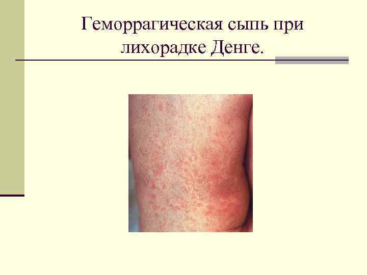 Геморрагическая сыпь при лихорадке Денге. 