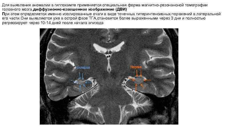 Для выявления аномалии в гиппокампе применяется специальная форма магнитно-резонансной томографии головного мозга, диффузионно-взвешенное изображение