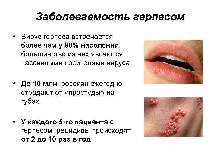 Заболеваемость герпесом • Вирус герпеса встречается более чем у 90% населения, большинство из них