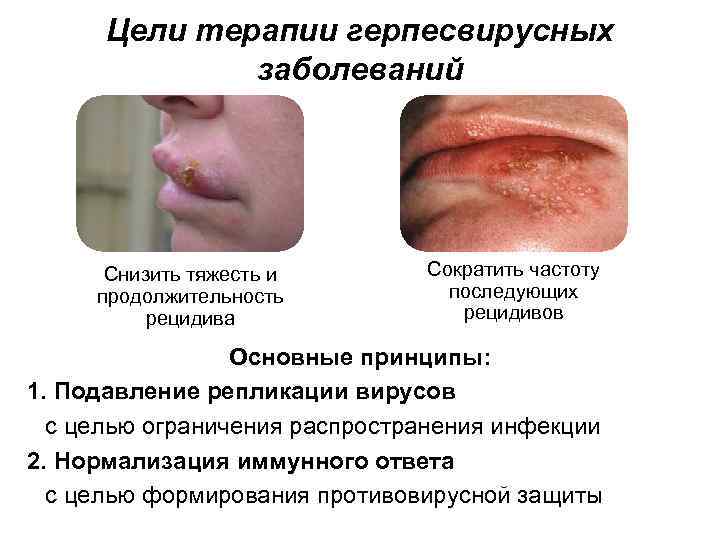 Цели терапии герпесвирусных заболеваний Снизить тяжесть и продолжительность рецидива Сократить частоту последующих рецидивов Основные