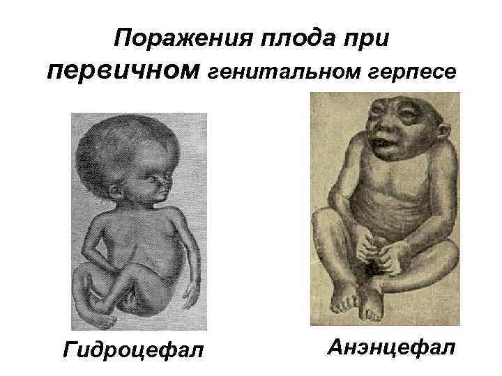Поражения плода при первичном генитальном герпесе Гидроцефал Анэнцефал 