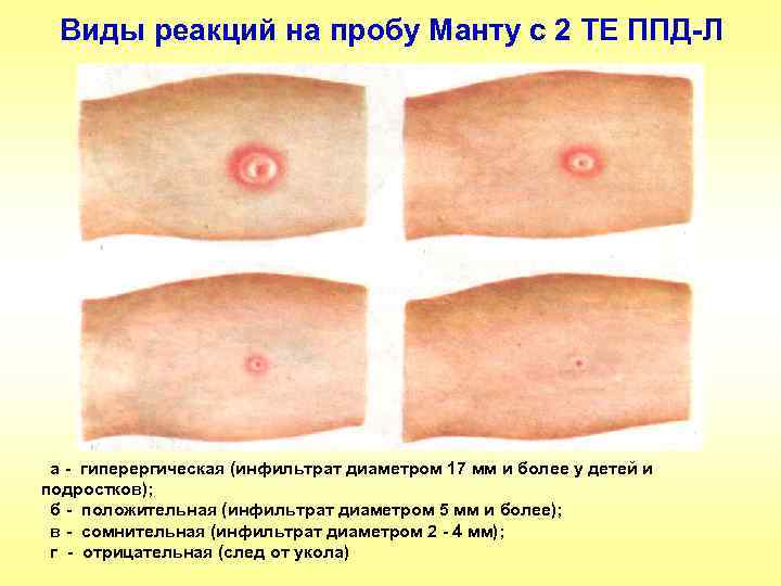 Виды реакций на пробу Манту с 2 ТЕ ППД-Л а - гиперергическая (инфильтрат диаметром