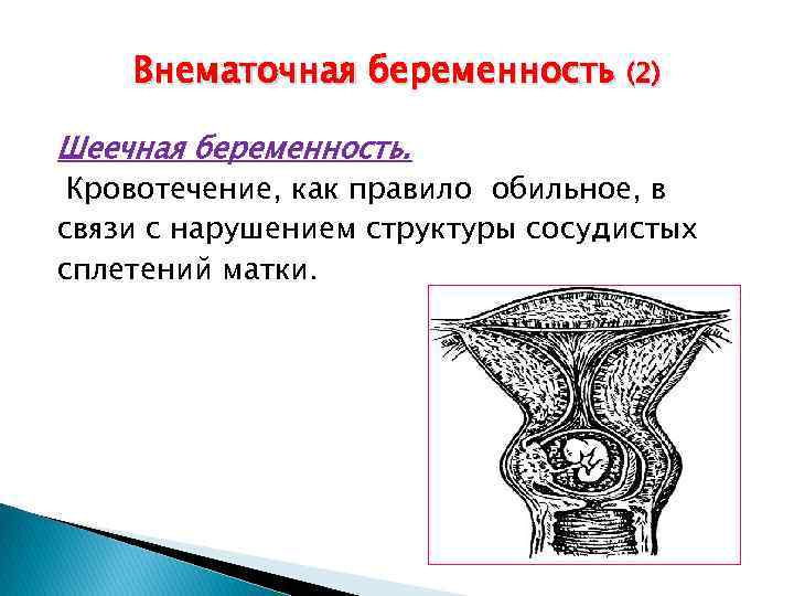 Внематочная беременность (2) Шеечная беременность. Кровотечение, как правило обильное, в связи с нарушением структуры