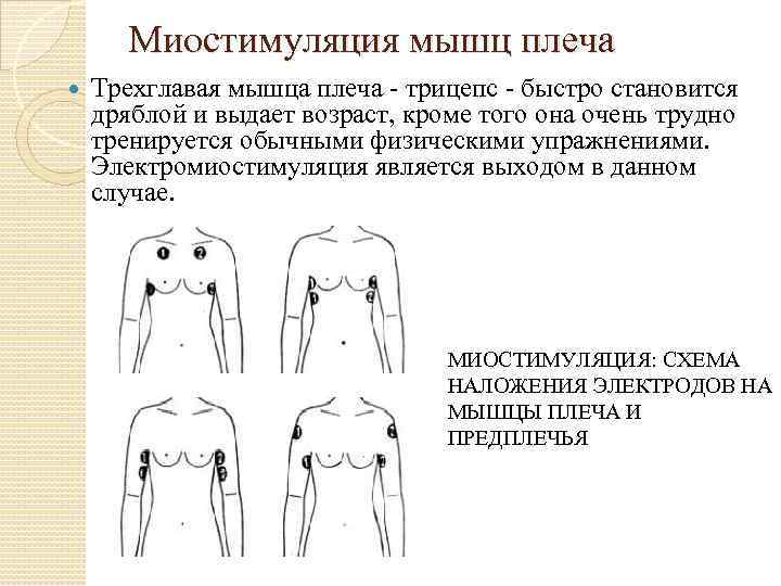 Миостимуляция точки наложения электродов схема