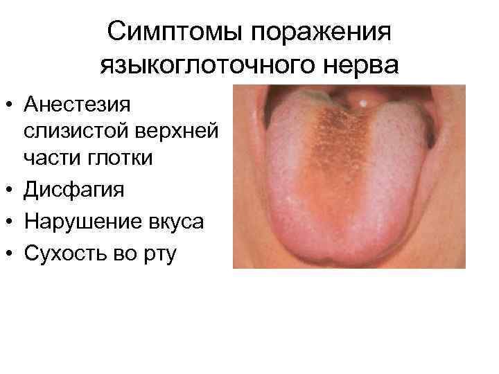 Симптомы поражения языкоглоточного нерва • Анестезия слизистой верхней части глотки • Дисфагия • Нарушение