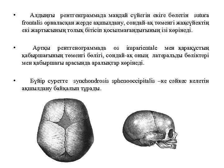  • Алдыңғы рентгенграммада маңдай сүйегін екіге бөлетін sutura frontalis орналасқан жерде ақшылдану, сондай-ақ