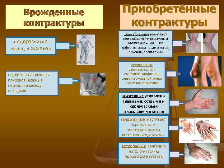 Врожденные контрактуры недоразвитие мышц и суставов недоразвитие кожных покровов (кожные перепонки между пальцами Приобретённые