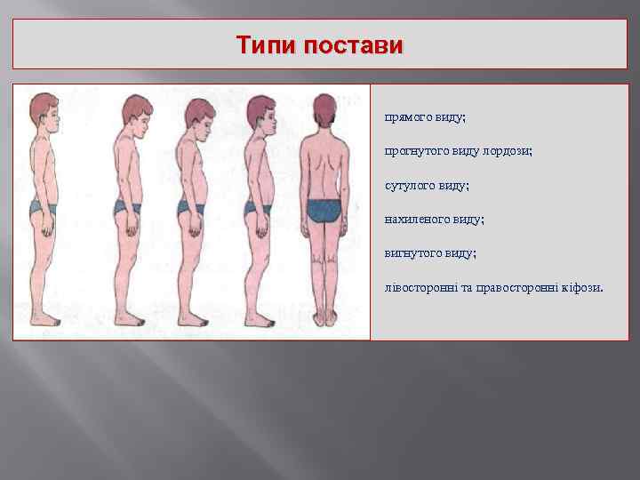 Типи постави прямого виду; прогнутого виду лордози; сутулого виду; нахиленого виду; вигнутого виду; лівосторонні