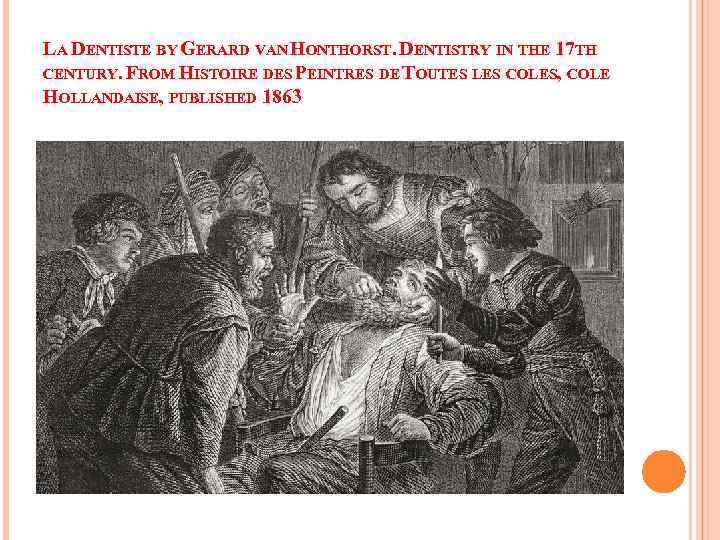 LA DENTISTE BY GERARD VAN HONTHORST. DENTISTRY IN THE 17 TH CENTURY. FROM HISTOIRE