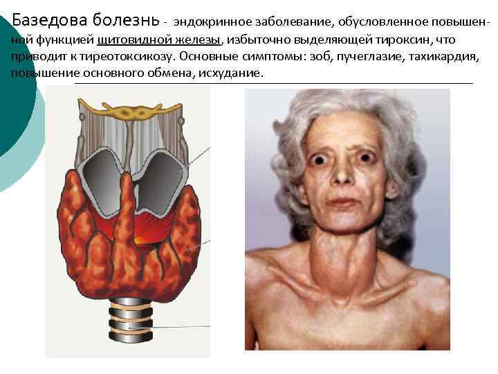 Базедова болезнь - эндокринное заболевание, обусловленное повышенной функцией щитовидной железы, избыточно выделяющей тироксин, что