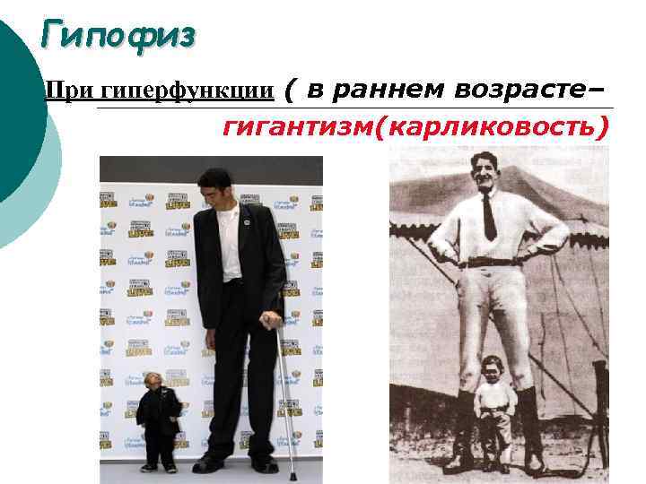 Гипофиз При гиперфункции ( в раннем возрасте– гигантизм(карликовость) 