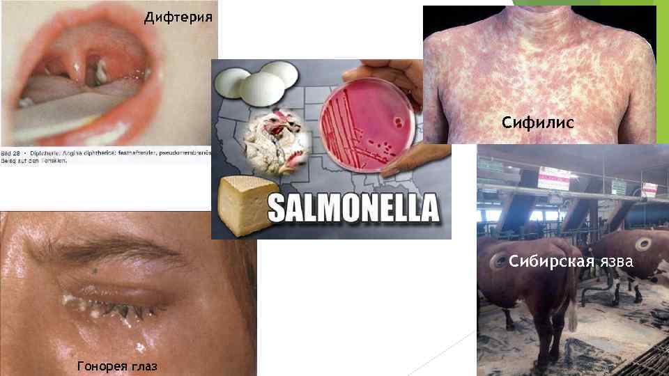 Дифтерия Сифилис Сибирская язва Гонорея глаз 