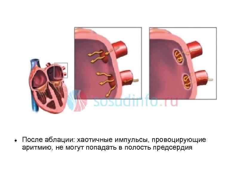  После аблации: хаотичные импульсы, провоцирующие аритмию, не могут попадать в полость предсердия 
