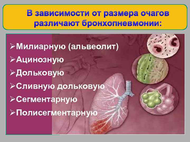 В зависимости от размера очагов различают бронхопневмонии: ØМилиарную (альвеолит) ØАцинозную ØДольковую ØСливную дольковую ØСегментарную