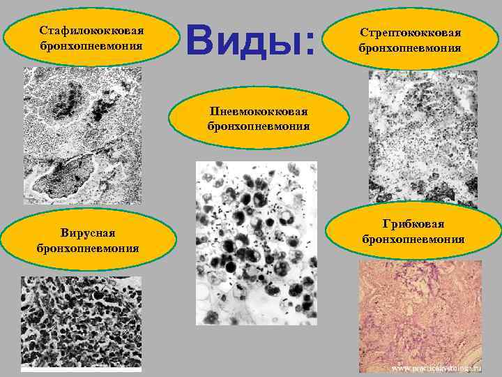 Стафилококковая бронхопневмония Виды: Стрептококковая бронхопневмония Пневмококковая бронхопневмония Вирусная бронхопневмония Грибковая бронхопневмония 