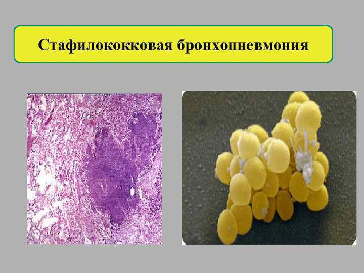 Стафилококковая бронхопневмония 