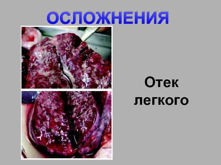 ОСЛОЖНЕНИЯ Отек легкого 