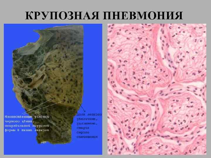 КРУПОЗНАЯ ПНЕВМОНИЯ 