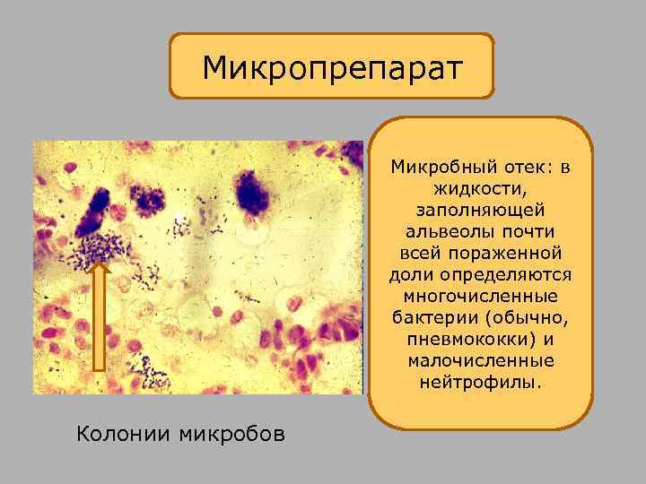 Микропрепарат Микробный отек: в жидкости, заполняющей альвеолы почти всей пораженной доли определяются многочисленные бактерии