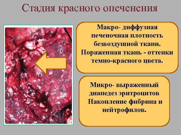 Стадия красного опеченения Макро- диффузная печеночная плотность безвоздушной ткани. Пораженная ткань - оттенки темно-красного