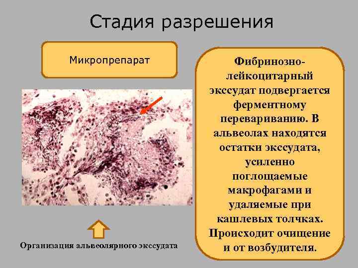 Стадия разрешения Микропрепарат Организация альвеолярного экссудата Фибринознолейкоцитарный экссудат подвергается ферментному перевариванию. В альвеолах находятся