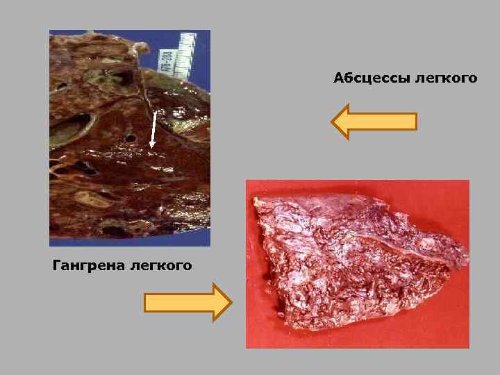 Абсцессы легкого Гангрена легкого 