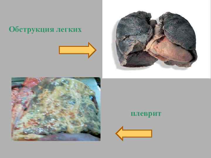 Обструкция легких плеврит 