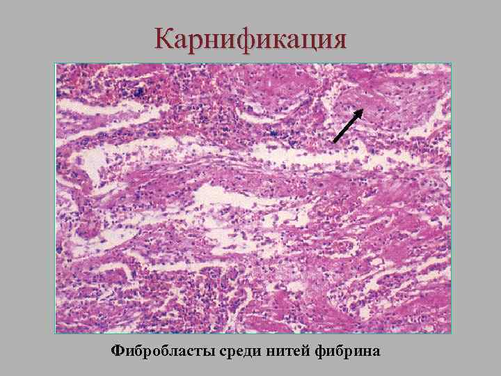 Карнификация Фибробласты среди нитей фибрина 