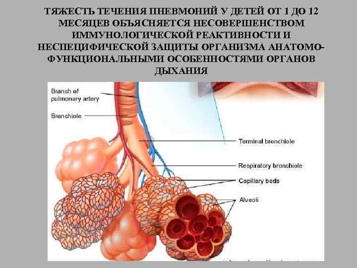 ТЯЖЕСТЬ ТЕЧЕНИЯ ПНЕВМОНИЙ У ДЕТЕЙ ОТ 1 ДО 12 МЕСЯЦЕВ ОБЪЯСНЯЕТСЯ НЕСОВЕРШЕНСТВОМ ИММУНОЛОГИЧЕСКОЙ РЕАКТИВНОСТИ