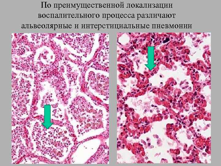 По преимущественной локализации воспалительного процесса различают альвеолярные и интерстициальные пневмонии 