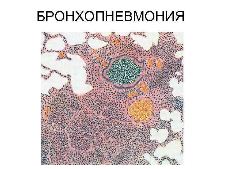 БРОНХОПНЕВМОНИЯ 