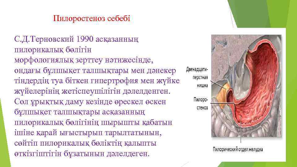 Пилоростеноз себебі С. Д. Терновский 1990 асқазанның пилорикалық бөлігін морфологиялық зерттеу нәтижесінде, ондағы бұлшықет