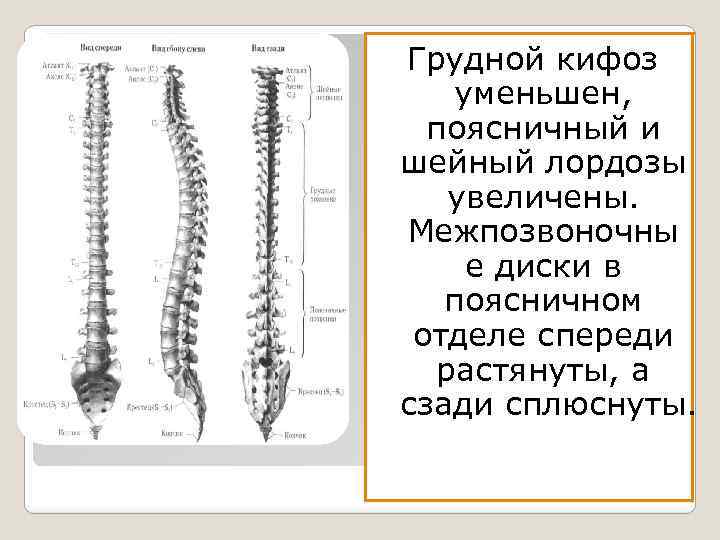 Грудной кифоз