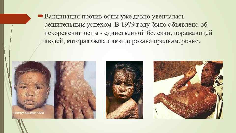  Вакцинация против оспы уже давно увенчалась решительным успехом. В 1979 году было объявлено