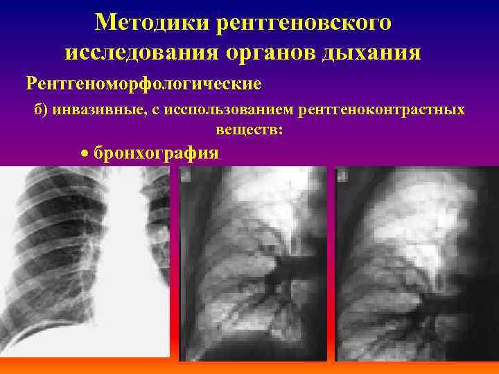 Методики рентгеновского исследования органов дыхания Рентгеноморфологические б) инвазивные, с исспользованием рентгеноконтрастных веществ: · бронхография
