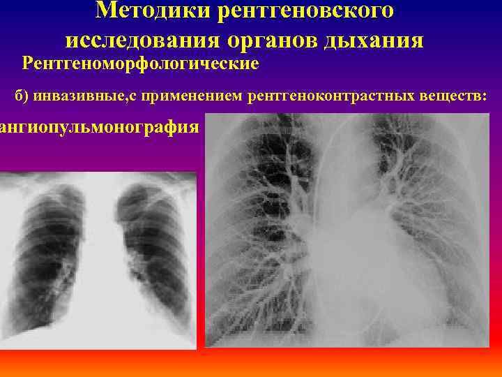 Методики рентгеновского исследования органов дыхания Рентгеноморфологические б) инвазивные, с применением рентгеноконтрастных веществ: ангиопульмонография 
