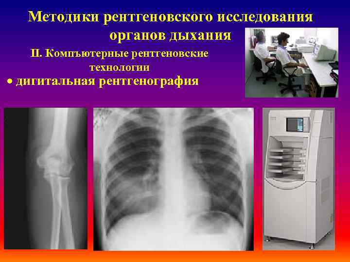 Методики рентгеновского исследования органов дыхания ІІ. Компъютерные рентгеновские технологии · дигитальная рентгенография 